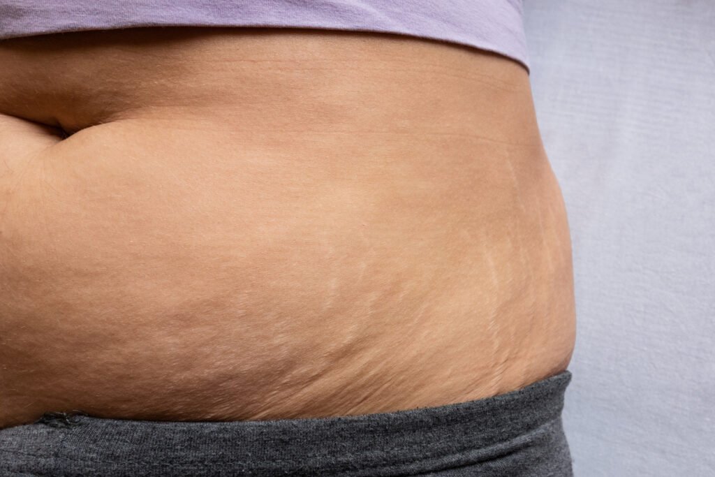 Skin Tightening after Liposuction at Uma Clinic Seattle