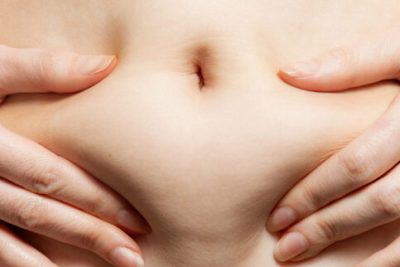 A woman holds her hands to her stomach, pulling the skin with fat. Close-up of the abdomen and navel. The concept of obesity, weight loss and liposuction.