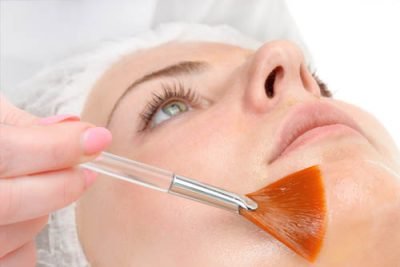 chemicalpeel